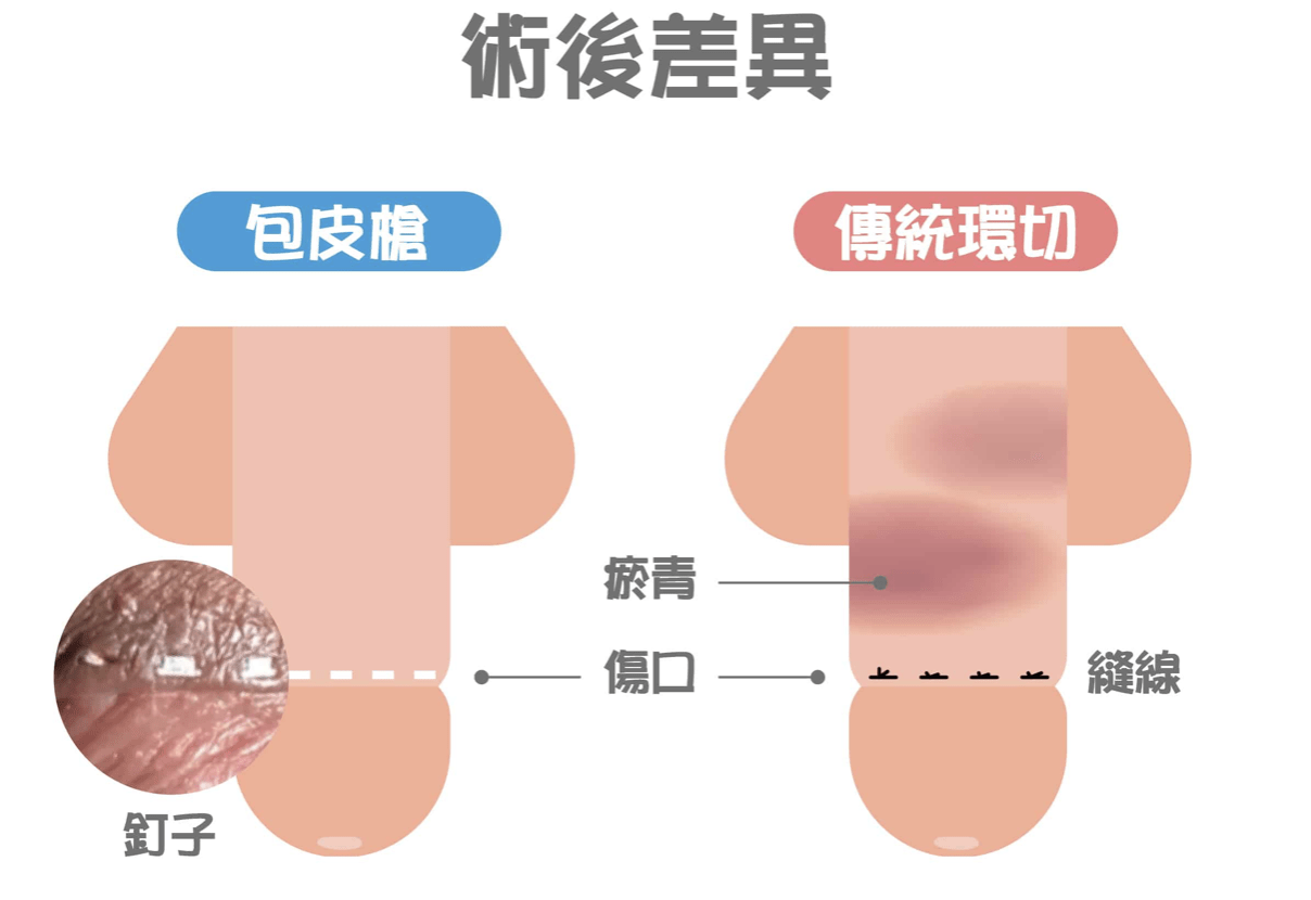 包皮超人是我啦👌🏻貼心女友的割包皮指南 - 感情板 | Dcard