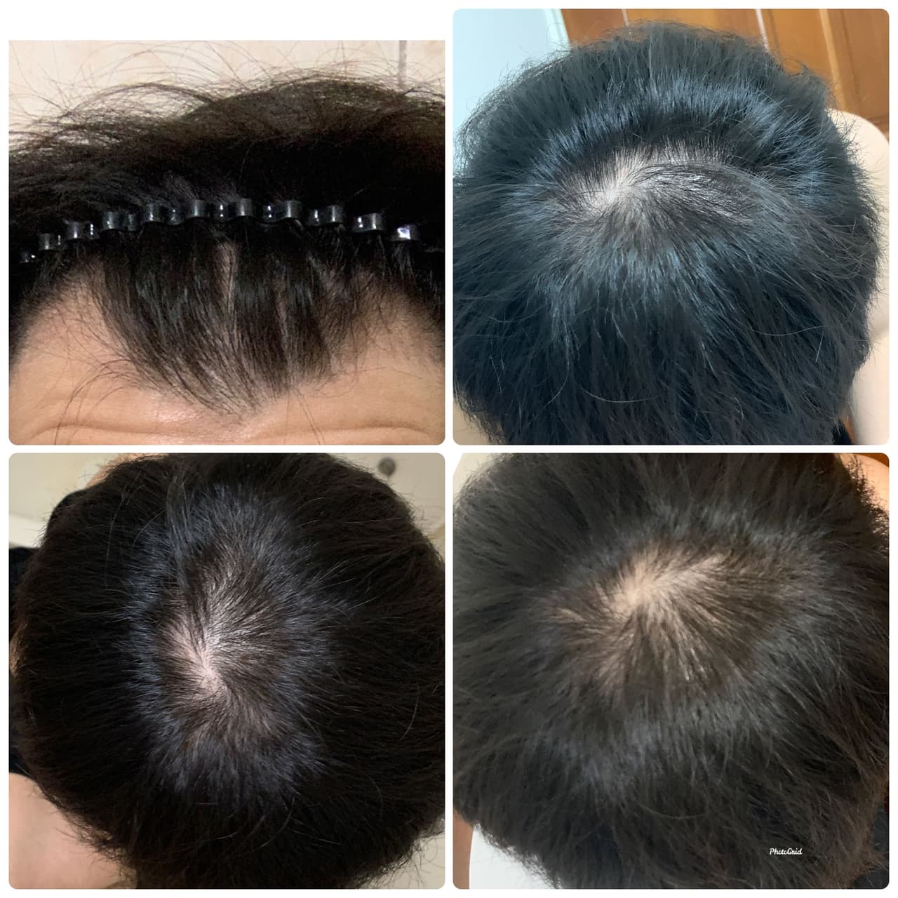 吃波斯卡,教你切?不用切藥器啊(抗禿實測 - 心情板 | Dcard