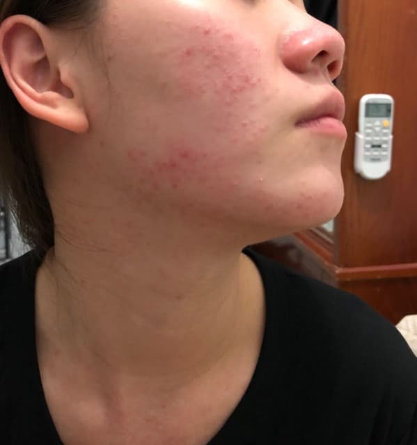 輕鬆美膚ezskin 高效抗痘修護凝膠使用似乎過敏 美妝板 Dcard