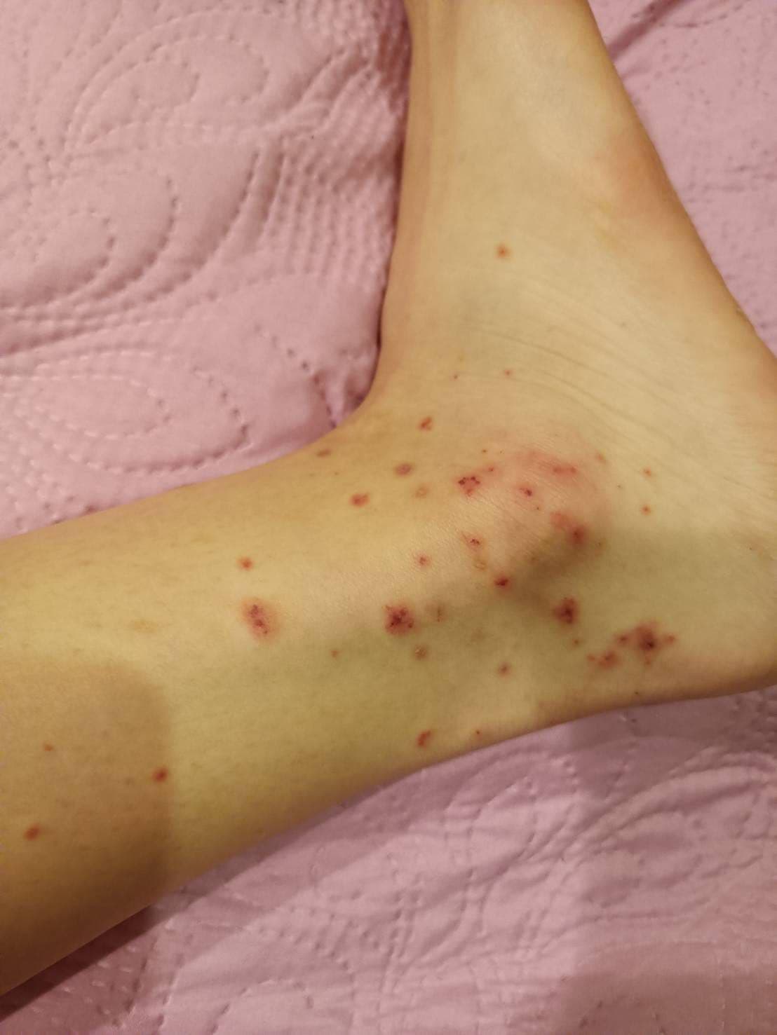 腿上長一堆紅點（有圖慎入- 女孩板| Dcard